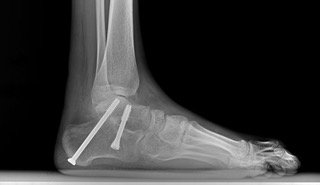 APMA's tweet photo. #WednesdayWisdom Highly divergent screw fixation for #subtalar #arthrodesis found to have the highest torsional stability in both inversion & eversion compared to minimally divergent and single screw fixation methods. https://t.co/UgsG5GMlaw #APMA #FootandAnkleSurgeon #podiatry https://t.co/GXDiNJs9Ha