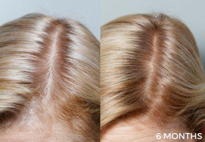 EncinitasDirect's tweet image. #Photo: #Encinitas hair loss from Healthy Hair Nectar - bit.ly/2zAEj08