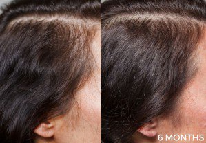 EncinitasDirect's tweet image. #Photo: #Encinitas hair loss from Healthy Hair Nectar - bit.ly/2zE1yGo