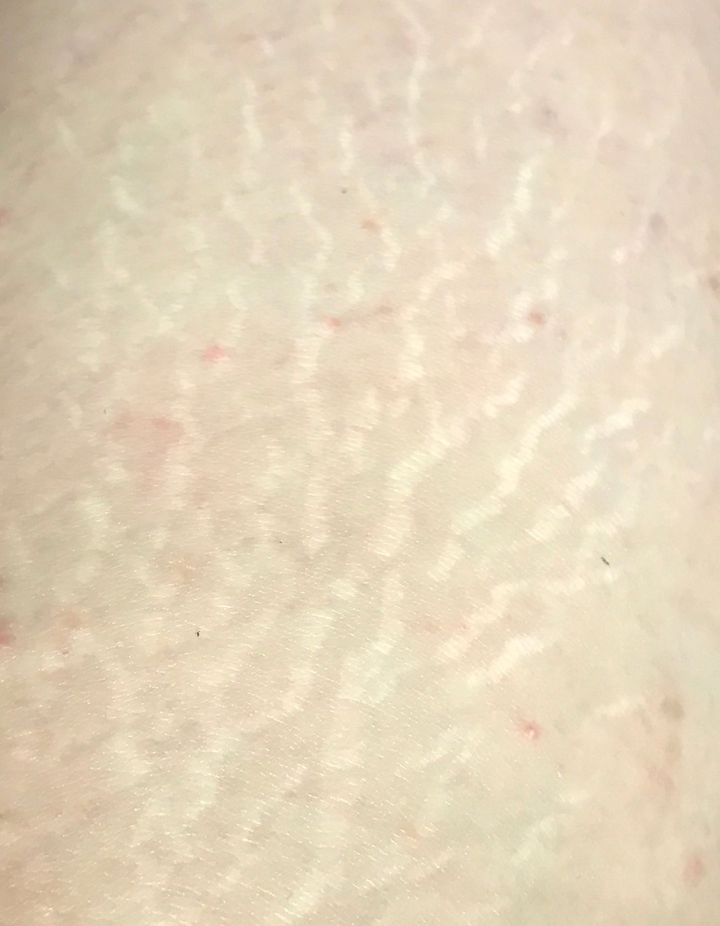 Mi 肉割れ治療2回目 太もも 外側 1枚目 肉割れ治療前 2枚目 治療直後 3枚目 治療4日後 4枚目 治療2ヶ月後