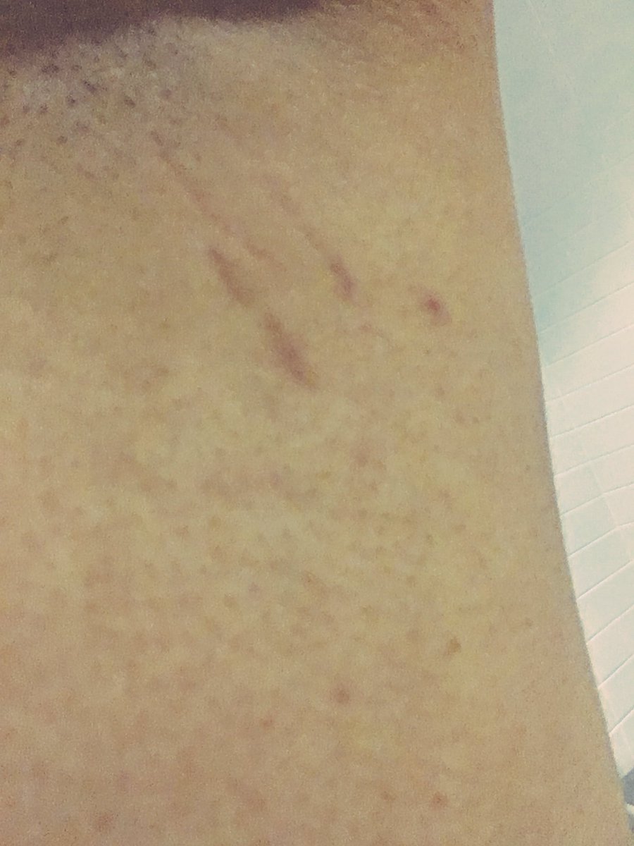 Jaken491's tweet image. Tfw your new stretch marks are everywhere and it's weird but also really cool 🤓🌸 #secondpuberty