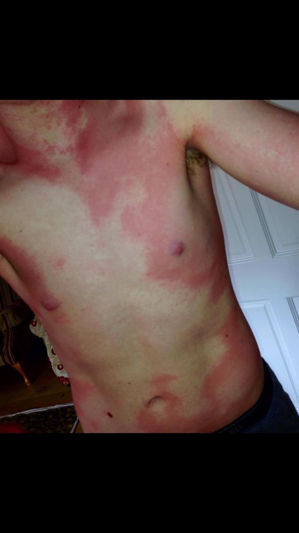Describe this rash. What is the differential diagnosis?msurgery.ie/pgcases/pg-cas…