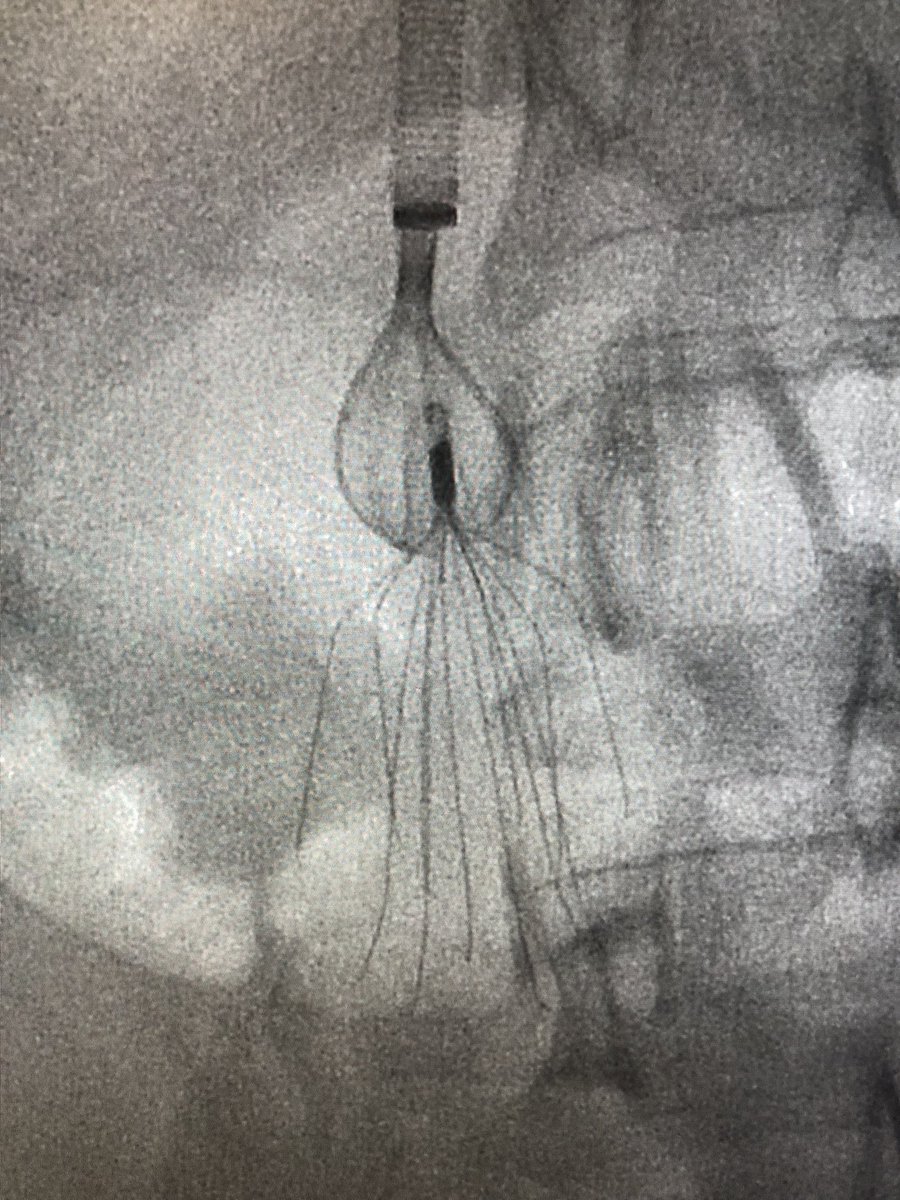 UCD_IR's tweet image. 8 year-old Bard Meridian #filterOUT. Surrendered to Avantec’s Captus device. @rkryu @kush_r_desai @NorthwesternIR #iRad #GTFO