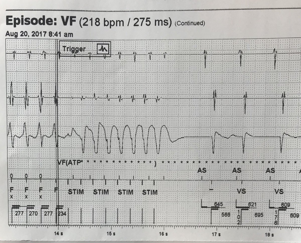 friemx's tweet photo. Interesting initiation of vt with atrial tach and termination with ATP @arorasandeep24 @jeffreycliu1980 @jonascooperEP https://t.co/5LMNo3KXb5