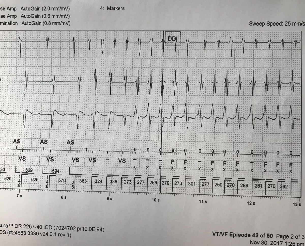 friemx's tweet photo. Interesting initiation of vt with atrial tach and termination with ATP @arorasandeep24 @jeffreycliu1980 @jonascooperEP https://t.co/5LMNo3KXb5