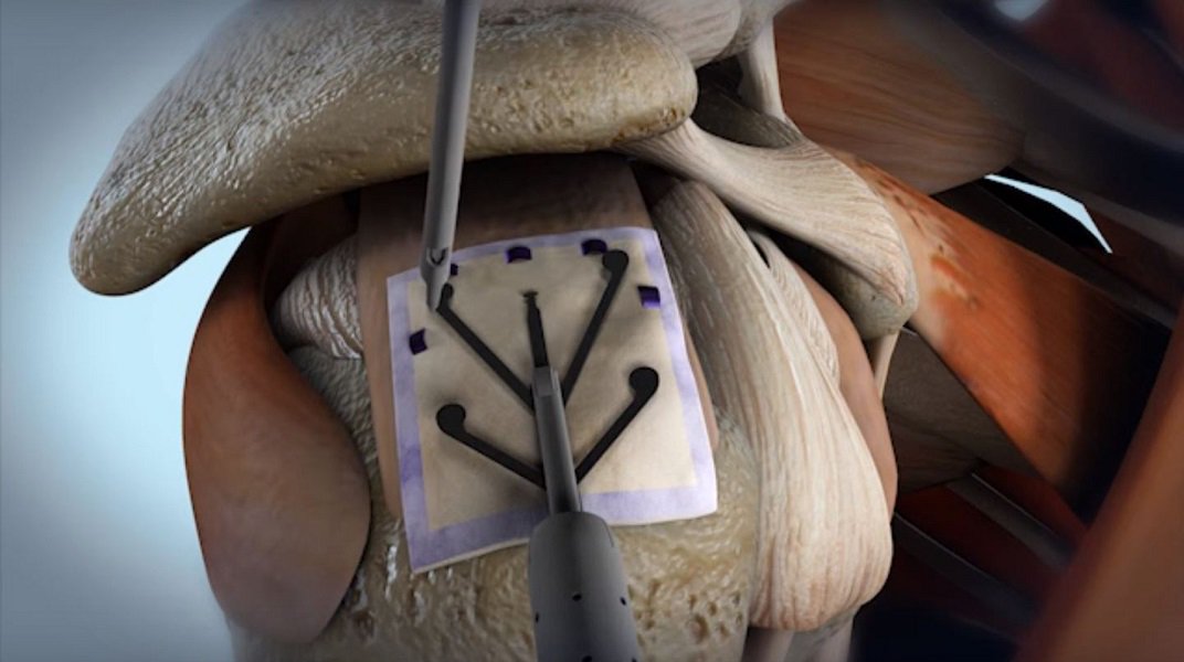 PeterCoffaro's tweet photo. Rotation Medical Bioinductive Implant Promotes Consistent Rotator Cuff Healing, Mitigates Tear Progression https://t.co/Gfx2GvrzgF @RotationMedical #bioinductive #implants #meddevice #medtech #orthopedics #RotatorCuffRepair https://t.co/ao82TBsWYc