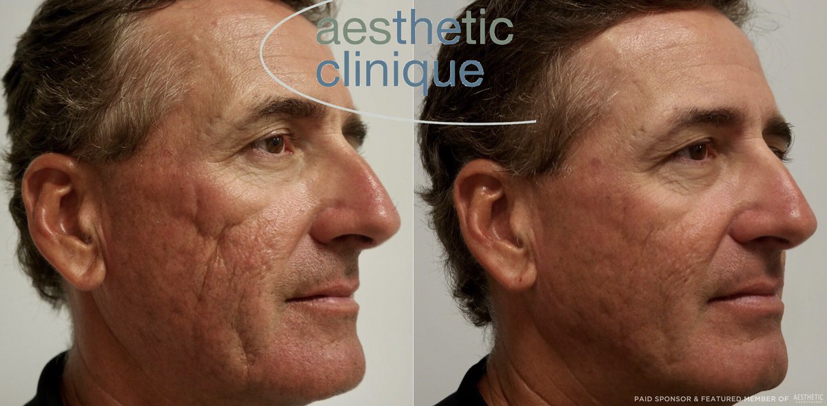 AestheticEvExpo's tweet photo. AMAZING results for facial scarring done by Dr. Weiner @THEClinique. 🙌🏼 This required 10 syringes of Bellafill. The after results are 6 months after the last treatment. He is starting a series of Infini treatments to get further improvements.
#bellafill #suneva #plasticsurgery https://t.co/gGSGkEG19e