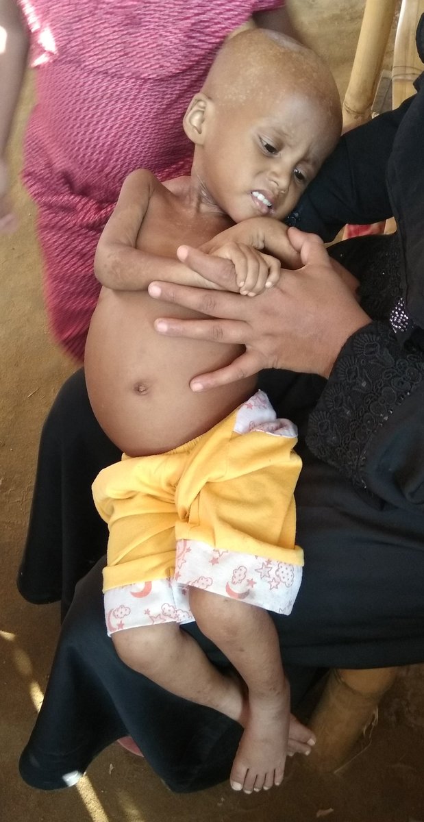 abdullah_nut's tweet photo. Snapshots of #NutritionActionWeek 
#screening of 6-59 month #Rohingya children to detect and refer children with #SevereAcuteMalnutrition, #VitaminASupplementation #Deworming of 24-59m #Rohingya children

@UNICEFBD @UN
#Unite4NutritionBangladesh 
#ZeroHunger
@UNICEF_uk 
@UNICEF https://t.co/Ncu4fhNm0F
