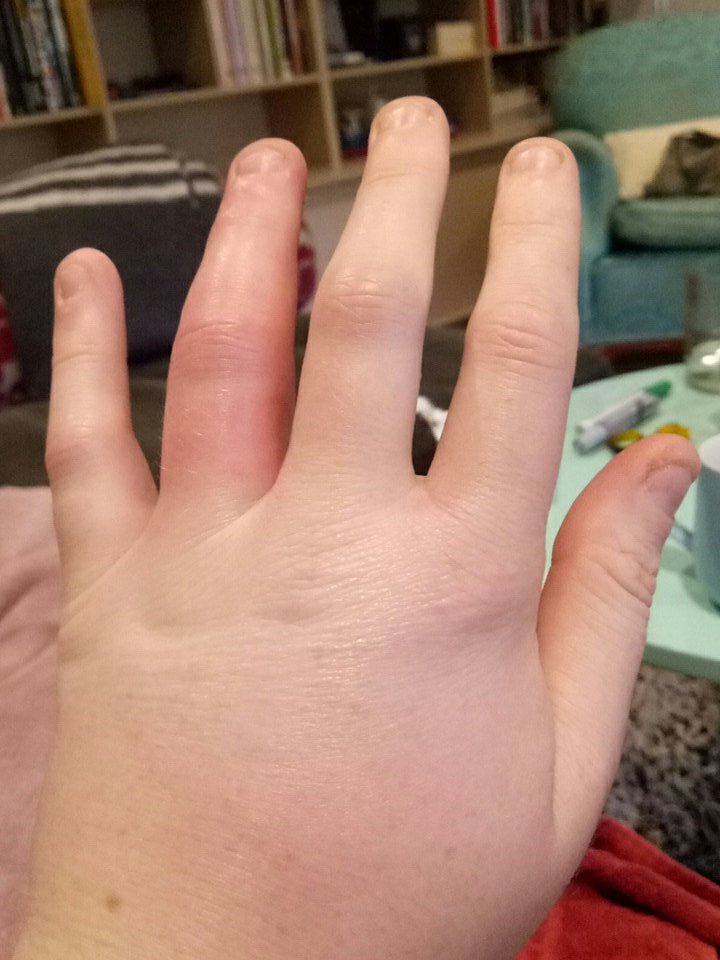 rloneyhowes's tweet photo. #fathand #beesting #lefthanded! https://t.co/5NyjhIbe27