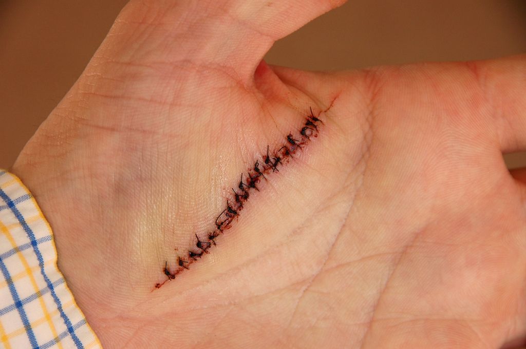 3EMagazine's tweet photo. Medical Devices Replaces Stiches! https://t.co/Qd5jGhG7qC https://t.co/MoJEA8HZ3L