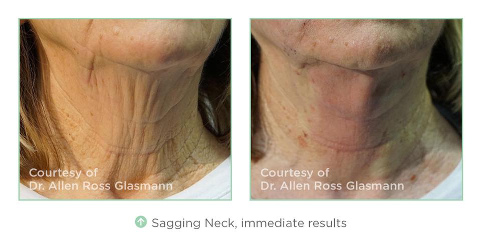 skinmedequip's tweet photo. #NovaThreads can be inserted/injected almost anywhere, one particular area that was  missing a non-surgical procedure is the area of the jaw and the neck. Contact us today for more information. https://t.co/RwWnXHf2gH #skinmedicalequipment #medicallaser #healthytips #aesthetic https://t.co/8u50s4QSzf