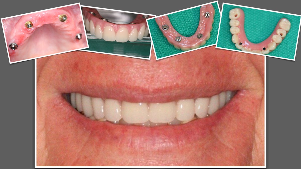 Happy Straumann ProArch patient today in West TX! #straumann