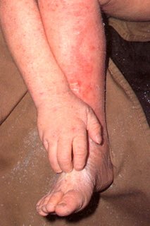 ckbridgett's tweet photo. @eczemasupport 💡... after #HabitReversal less topical treatment is required - both #Steroids & #Emollients: #lichenification needs #HabitReversal ! https://t.co/mJwT8SxUzt https://t.co/agA7BanFWa