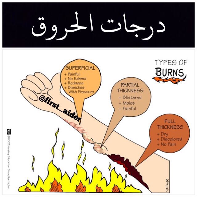 Reemo_08's tweet image. #firstsid #first_aid #إسعافات_اوليه #الحروق #مصاب