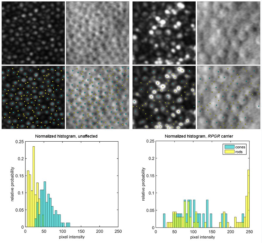 UCL_Retina's tweet photo. Cellular Imaging of the Tapetal-like Reflex in Carriers of RPGR-Associated Retinopathy. @RetinaJournal #RPGR #AdaptiveOptics #OCT 

https://t.co/eA7QVSVQQn https://t.co/RlAY5v87ug