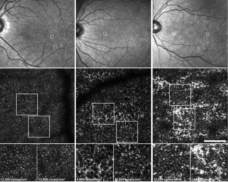 UCL_Retina's tweet photo. Cellular Imaging of the Tapetal-like Reflex in Carriers of RPGR-Associated Retinopathy. @RetinaJournal #RPGR #AdaptiveOptics #OCT 

https://t.co/eA7QVSVQQn https://t.co/RlAY5v87ug