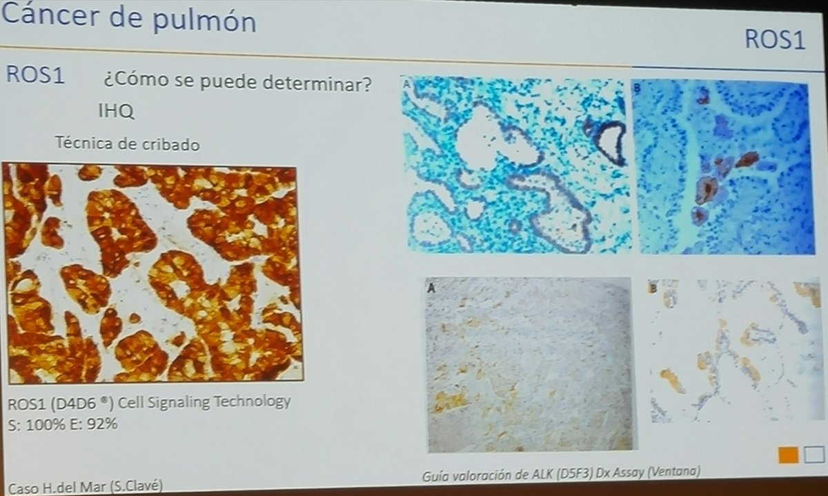 Histopatolomon's tweet photo. @lara_pijuan talking about #alk and #ros1 in lung cancer. #UpdateMM2017 @SEAP_IAP #lungcancer #pathology #pulmpath https://t.co/DsKHWNwouS