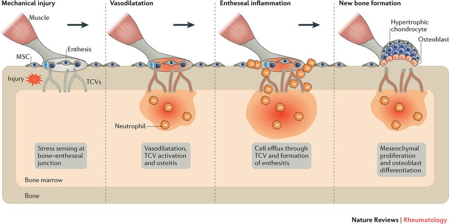DrAiLynTan's tweet photo. Nice review on #entheses #enthesitis
https://t.co/osI72Qmjmv
via @NatRevRheumatol
#enthesis #inflammation #spondyloarthritis #psoriaticarthritis #tendons #ligaments #bones #arthritis https://t.co/NixsGjXkzR