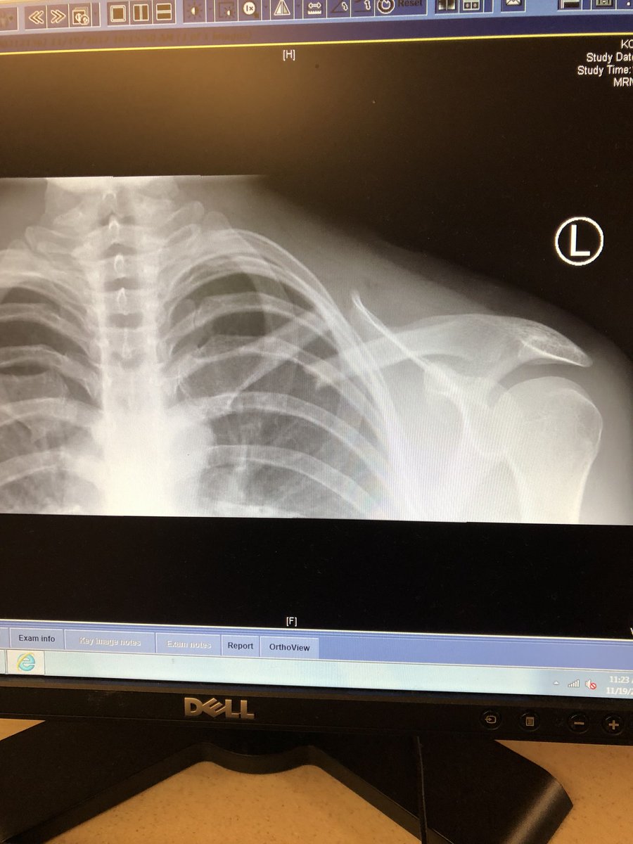 Komie says “it’s just a scratch, these pain meds are hitting me though” #ER