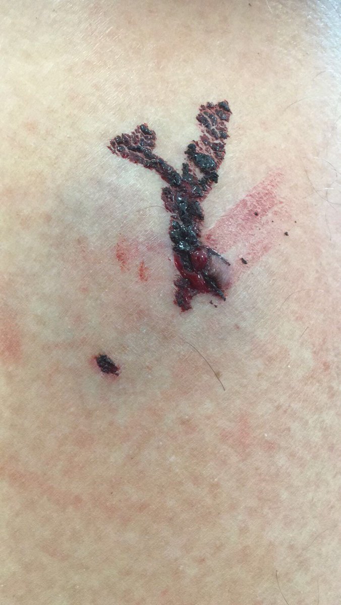 Nuclear Phoenix OCR (@nuclearphoenix_) on Twitter photo Ouch! OCR training can be painful - especially when a dog attacks you mid run! Trip for #PhoenixSteve to A&E!😢 <a href="/NukWildForest/">Nuclear Wild Forest</a> <a href="/TheNuclearRaces/">The Nuclear Races</a> @OCRChampionship #lovemud #ocr Obstacle Course Training ObstacleTraining UK Obstacle Racing I Love Obstacle Racing <a href="/obstacleracemag/">Obstacle Racing</a> Ouch! OCR training can be painful - especially when a dog attacks you mid run! Trip for #PhoenixSteve to A&E!😢 <a href="/NukWildForest/">Nuclear Wild Forest</a> <a href="/TheNuclearRaces/">The Nuclear Races</a> @OCRChampionship #lovemud #ocr Obstacle Course Training ObstacleTraining UK Obstacle Racing I Love Obstacle Racing <a href="/obstacleracemag/">Obstacle Racing</a>