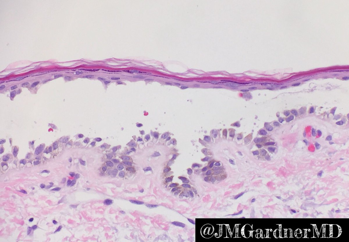 JMGardnerMD's tweet photo. Suprabasilar blister w "tombstone row" of basal keratinocytes. Pemphigus? No! Just Grover's disease. Clinical info = crucial in #dermpath! https://t.co/ixPBClKjUS