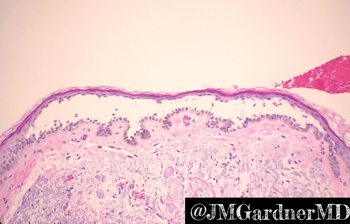 JMGardnerMD's tweet photo. Suprabasilar blister w "tombstone row" of basal keratinocytes. Pemphigus? No! Just Grover's disease. Clinical info = crucial in #dermpath! https://t.co/ixPBClKjUS