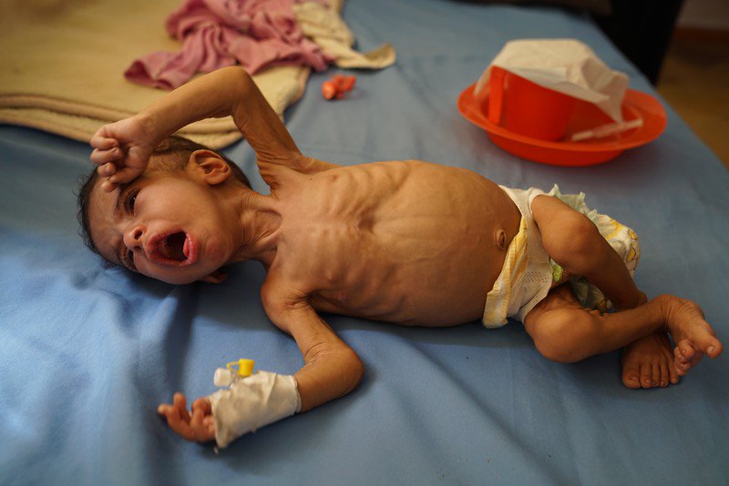 The lives of about 150,000 #children in #Yemen suffering from Severe Acute Malnutrition are at immediate risk if humanitarian organisations are not able to re-supply nutrition stocks for the coming months. #WorldChildrensDay #LetAidin