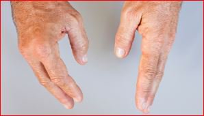 BMJLearning's tweet photo. Our case-based module on assessing and managing patients with #jointswelling in the hospital setting has just been updated. #rheumatology #internalmedicine #medtrainee #cmt #eportfolio #cpd https://t.co/41zxTr6W2x