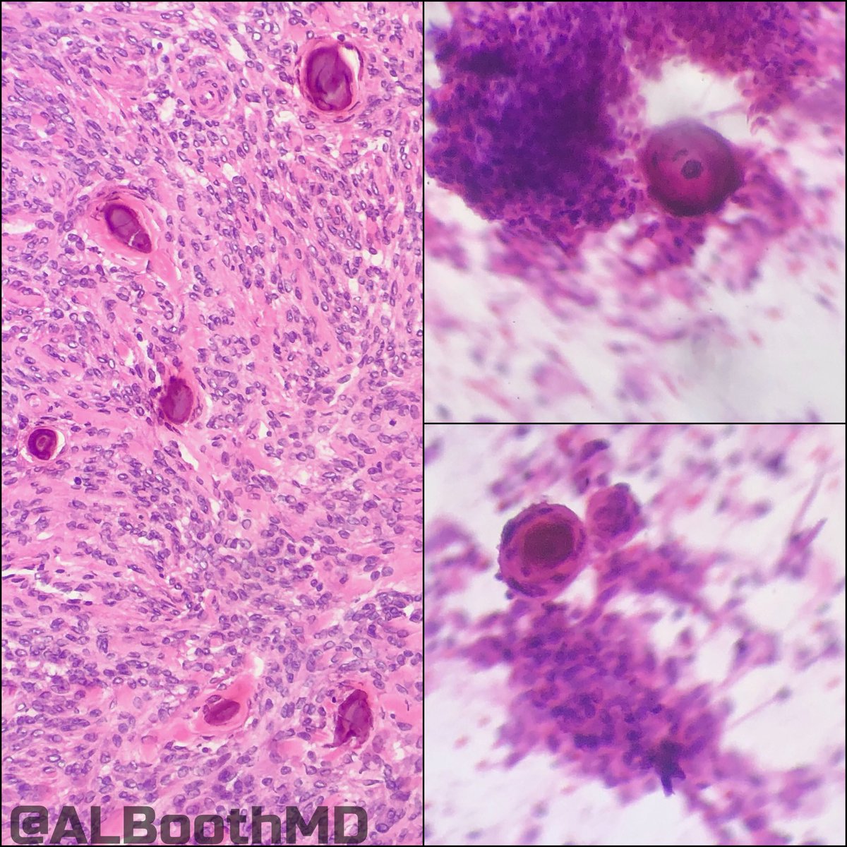 UTMB_Pathology's tweet photo. Firm, white, homogeneous dural mass, diagnosis? #neuropath great frozen &amp; touch prep by @MFahdkhalil #likeaboss https://t.co/zg6Odo5ovE