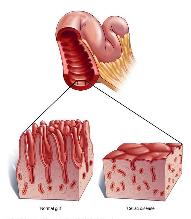 🔴السيلياك “Celiac disease”
هو مرض مناعي وراثي، يتم تحفيزه عن طريق استهلاك بروتين يسمى بالقلوتين الذي يتواجد في القمح 🥖🍞
وما يحدث هو عند تناول مريض السيلياك للقلوتين تقوم المناعة بالاستجابة عن طريق إتلاف الزغبات التي تشبه الأصبع في الأمعاء الدقيقة.
#معلومة_اليوم 💡💡