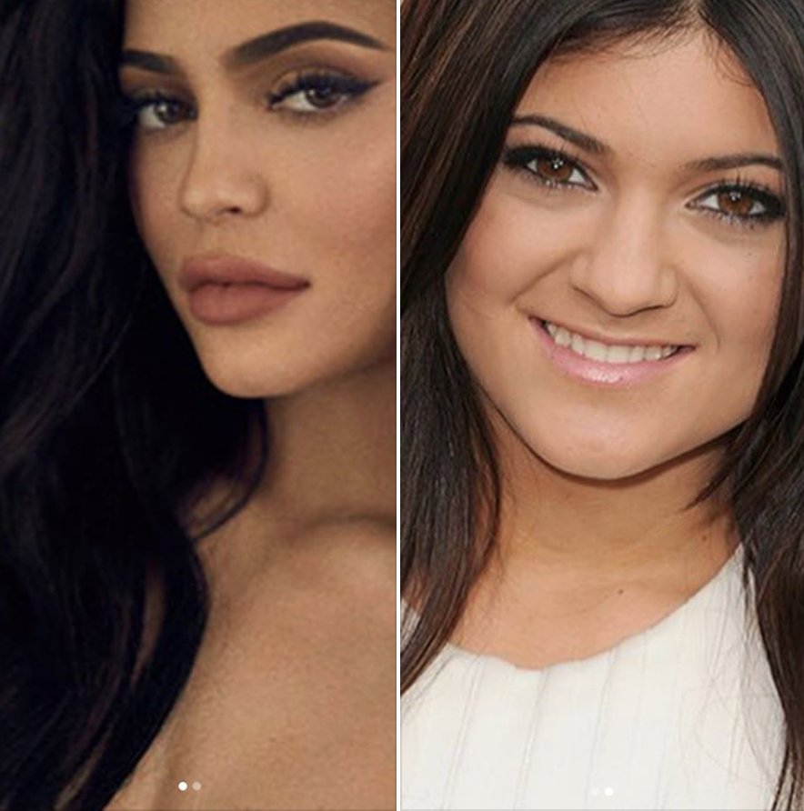 The full, pillowy #KylieJenner lip was all the craze for a few years but the shift has started and my clients prefer the #londonlook which is a natural enhancement instead of an obvious injection. #Lips #beforeandafter