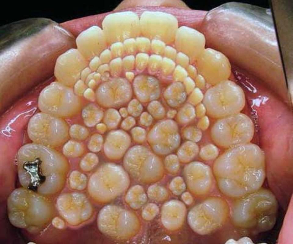 God__404's tweet photo. Inside the mouth of an adult suffering from Hyperdontia; you know, in gods image...

#NotPerfect #MistakesHappen in Evolution https://t.co/NLbYWjXbil