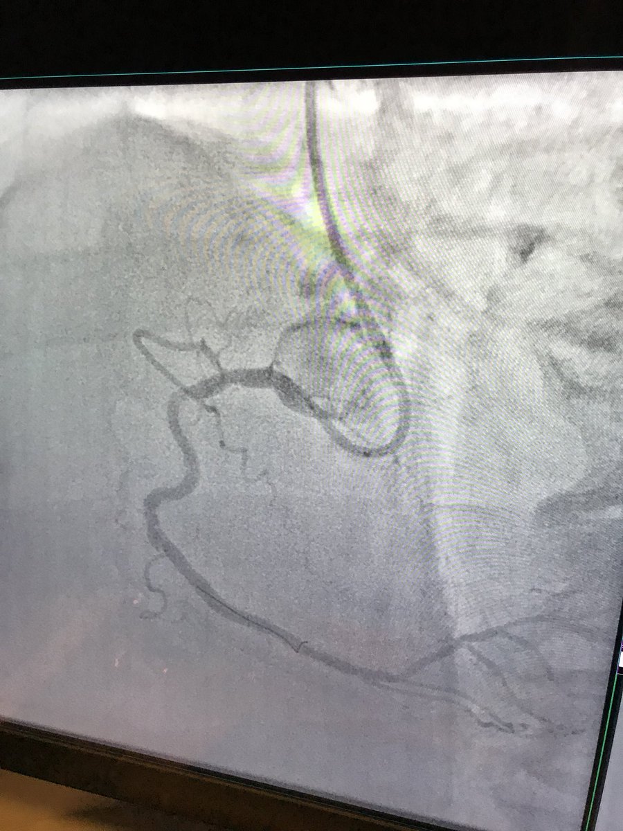 J Aaron Grantham JAG (@jag24851) on Twitter photo First dlTRI, second #roboticpci. Guideliner assisted RCA and LAD in OPTIMUM trial patient (surgical turndown). Win win. #RadialFirst #radialrobotics #MAHI. #teamwork! First dlTRI, second #roboticpci. Guideliner assisted RCA and LAD in OPTIMUM trial patient (surgical turndown). Win win. #RadialFirst #radialrobotics #MAHI. #teamwork!