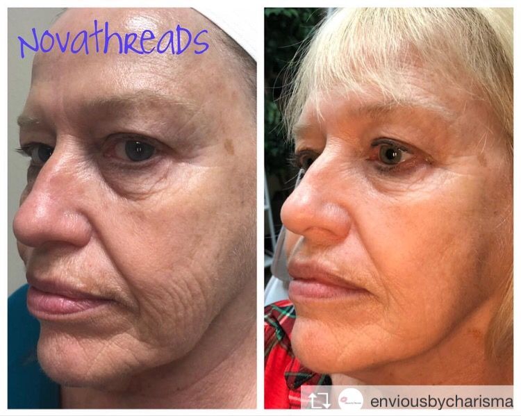 nlimedspa's tweet photo. PDO Novathreads help lift smooth and stimulate collagen!!! This is ONLY TWO WEEKS AFTER HER TREATMENT!
☎️Phone: 1(800)851-0969 https://t.co/GnMKC8cDnW