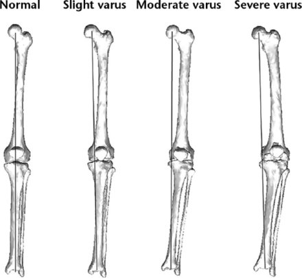 BoneJointRes's tweet photo. The application of #kinematically aligned total #knee #arthroplasty for severe #varus #knees may be #inadequate find @KyotoU_News researchers https://t.co/Q3g04YaJx5 https://t.co/P465HmBC4G