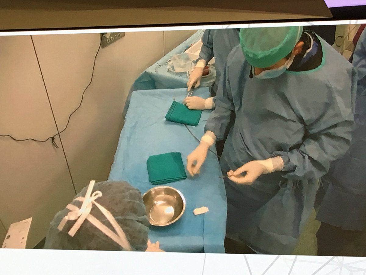 srdeleiras's tweet photo. Life left atrial appendage closure with Watchman device at #CSC2017, by Dr @icruzgonzalez https://t.co/IIRqPOKr3G