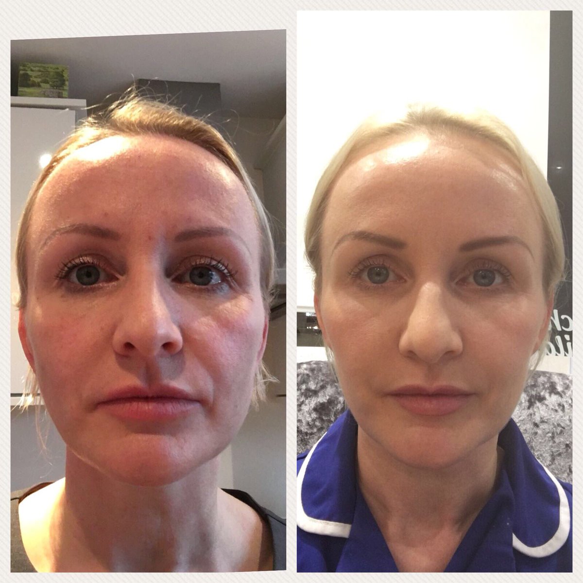 KGAesthetics's tweet photo. Botox to the Masseter for a wide set jaw. A small dosage was used to achieve a subtle slimmed down more contoured look to her lower face. Call or email now for a no obligation consultation #botox #botoxharrogate #harrogateaesthetics #aestheticclinic #masseterbotox https://t.co/s0b5nT5RlK