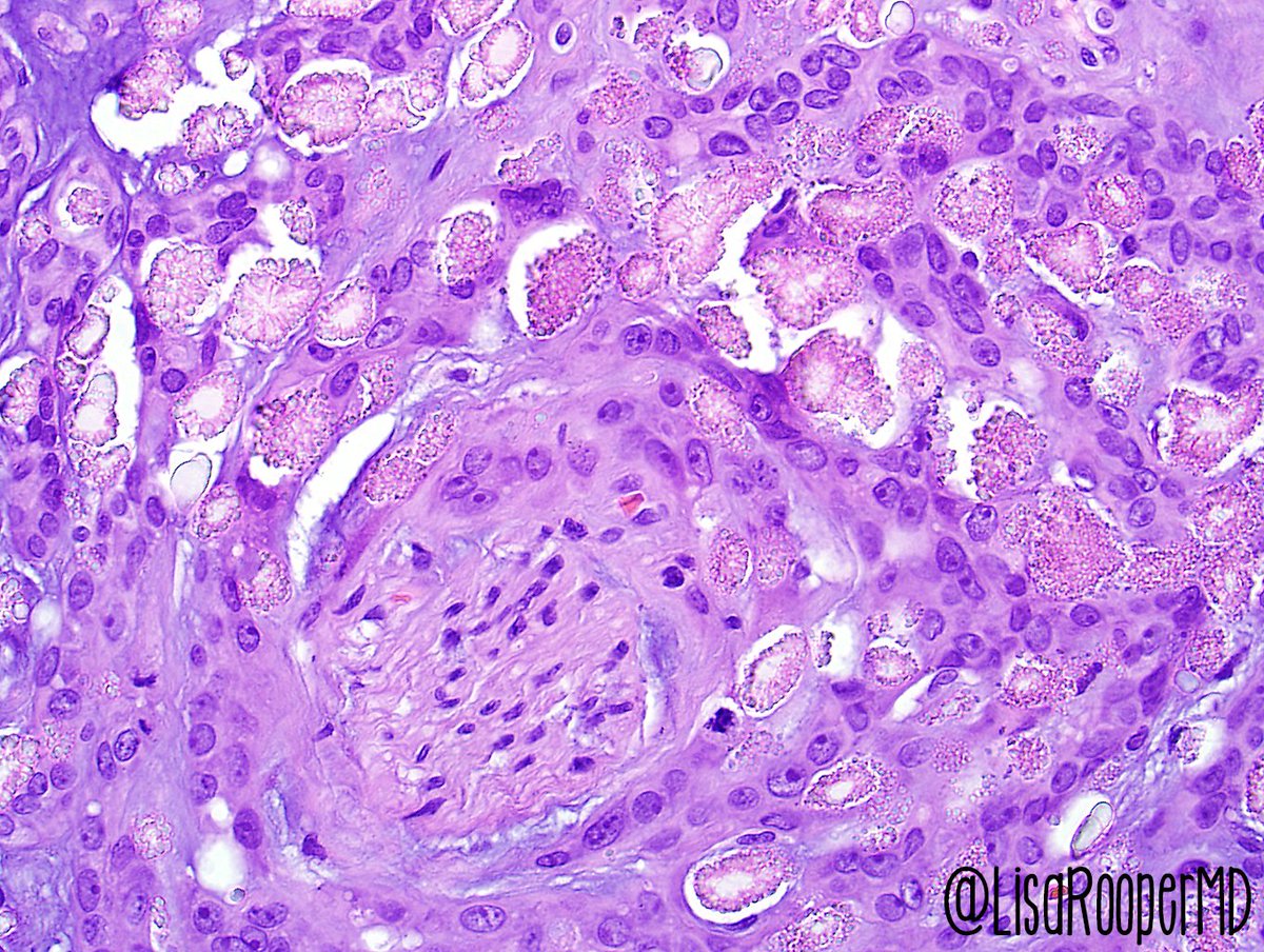 Adenocarcinoma And Related Tumors Of The Uterine Cervix