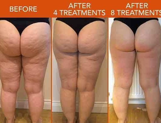 Seriously... these results 👌 
No filter need for this amazing result 💕
For a free consultation with Lisa DM us or call the spa directly on 02830278088 💕 #lipofirm #realresults #nofilter #weightloss #newry
