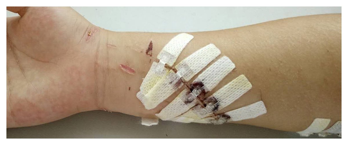 DermaClip's tweet image. Find the most advanced, non-invasive technique for Pediatric #wound_closure, Cesarean section, and more procedures with DermaClip® device!dermaclipus.com