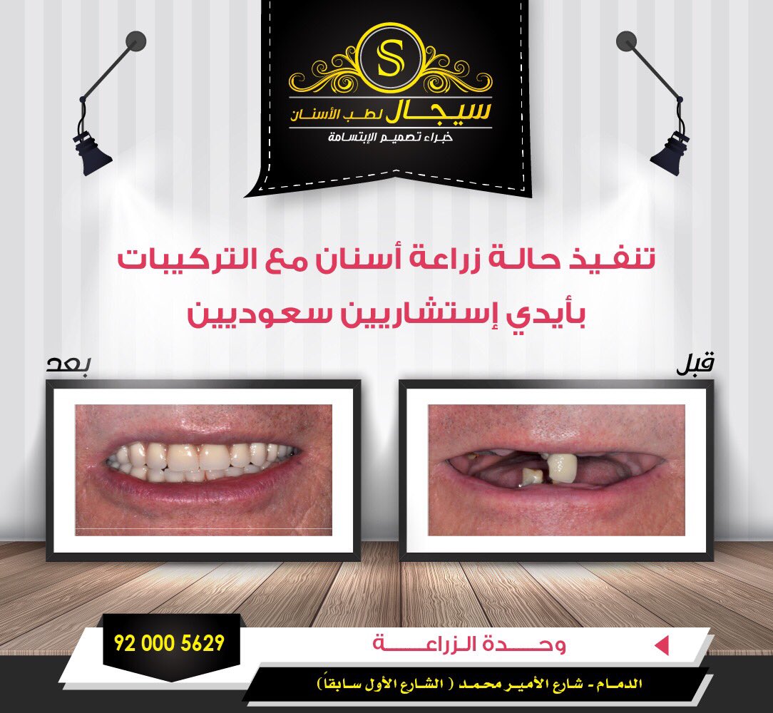مركز اضواء سيجال للأسنان V Tvittere شركات التامين لا تشمل عادة التركيبات و الزراعة