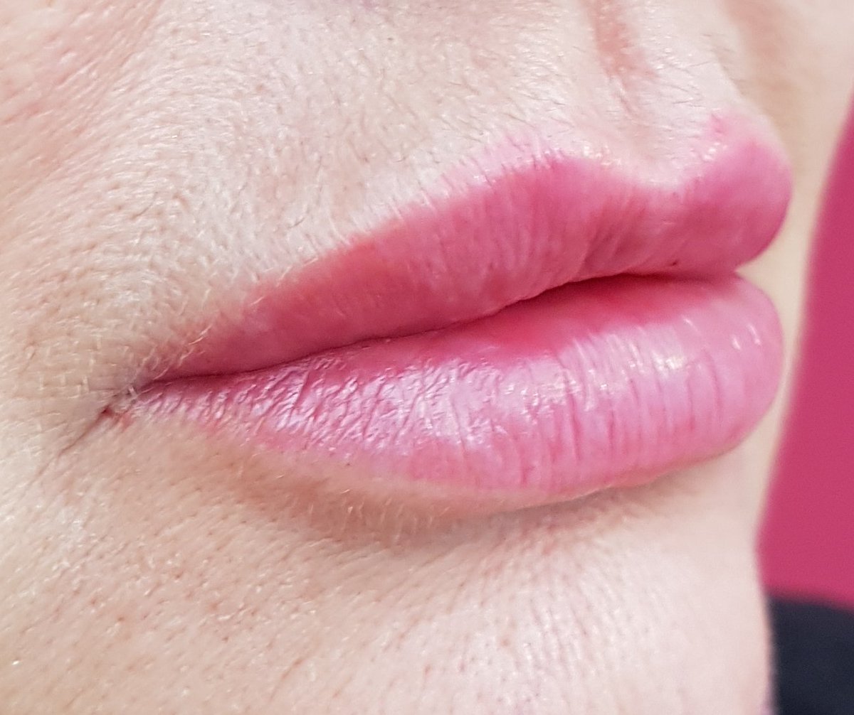 lip filllers for christmas at altered images#fullerlips#beautybirmingham#glamupyourlips#poutylips#aestheticsbirmingham#perfectpout#kissablelips