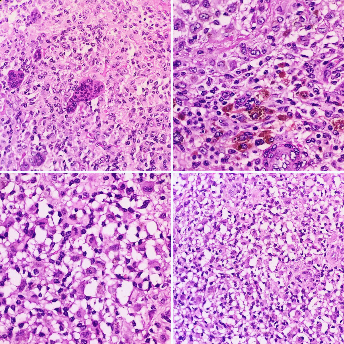 OlgerHatice's tweet photo. #patholog #pathologist #Turkpath Giant cell tumor of tendon sheath - localized type @pembeoltulu @duyguspath @kriyer68 @sirinozr @sultan_clskn_dr @levcan @Usubutun @koalaa35 @ERDENEROZER @ilkay1001 https://t.co/UQ4x6JqpMG