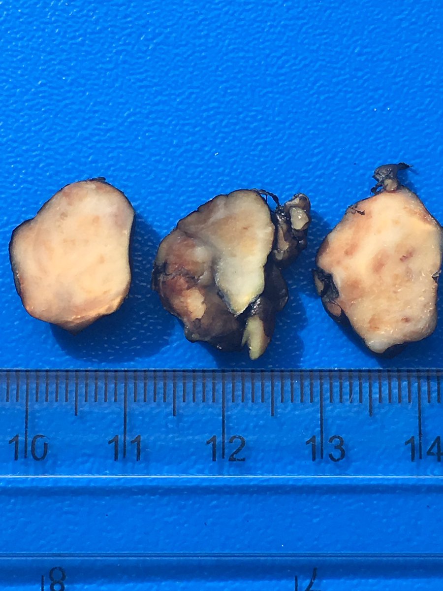 OlgerHatice's tweet photo. #patholog #pathologist #Turkpath Giant cell tumor of tendon sheath - localized type @pembeoltulu @duyguspath @kriyer68 @sirinozr @sultan_clskn_dr @levcan @Usubutun @koalaa35 @ERDENEROZER @ilkay1001 https://t.co/UQ4x6JqpMG