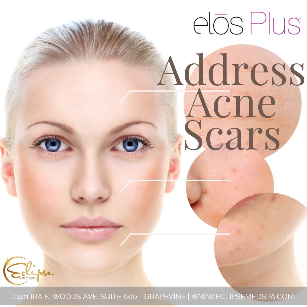 EclipseMedspa's tweet photo. #Acne can leave deep, noticeable scars that last a lifetime. Finally, there is a non-surgical, non-chemical toxic way to fade and eliminate them, with advanced clinical aesthetics and #Elos Plus. 

Visit our website to learn more. 

#Medspa #Grapevine #EclipseMedspa https://t.co/JspOXH6Z2i