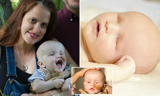 focusclinics's tweet image. @MailOnline has covered a mother of 10-month old baby born without eyes who is pleading for donations for pioneering bionic implants in the U.S. which could allow him to see!    buff.ly/2zPnrnk #eyesight #bionicimplants #blind #vision