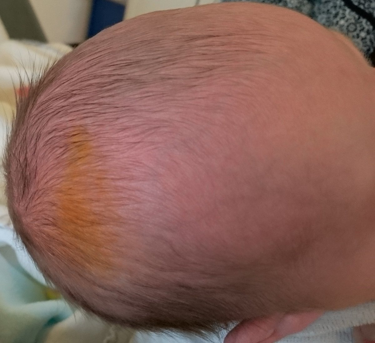 Dr Jean Jacques Fraslin En Twitter Doctoctoc Bebe 3 Semaines Ne Par Voie Basse Sans Forceps Ni Manipulation Qui Depuis 3 Jours Presente Cette Coloration Isolee Du Cuir Chevelu Sans Relief A La