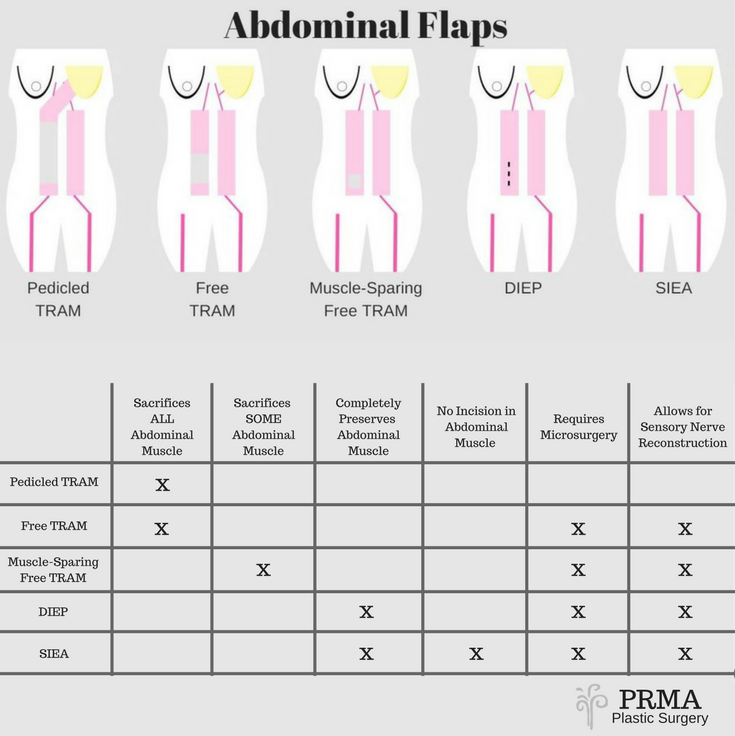 DiepFlapBreast's tweet photo. Abdominal Flap #BreastReconstruction options at a glance.
https://t.co/u6VlVANK1P https://t.co/G7VHvCEbvF
