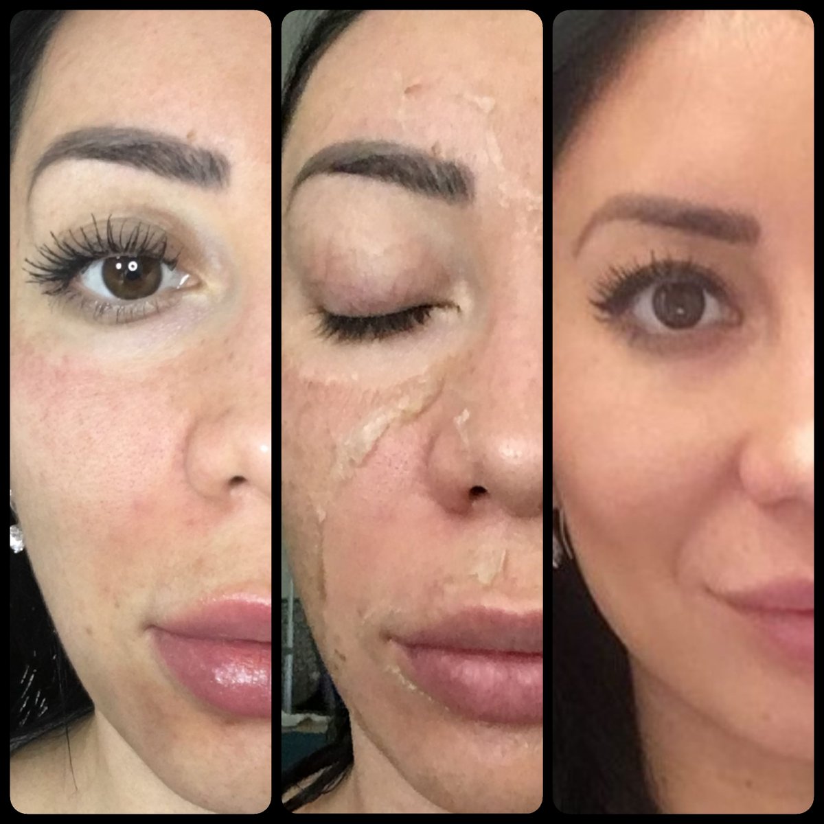 ThePerfectDerma's tweet image. Beautiful results for hyper pigmentation!  Middle photo is Day 3.