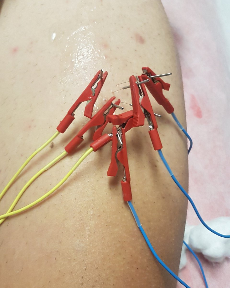 jordireigfisio's tweet photo. Vaya fiesta se han montado las agujitas y las pinzas ! @fisiojreig #Fisioterapia #Microcorrientes #Physioinvasiva @primfisio https://t.co/uNdMXkU9SN